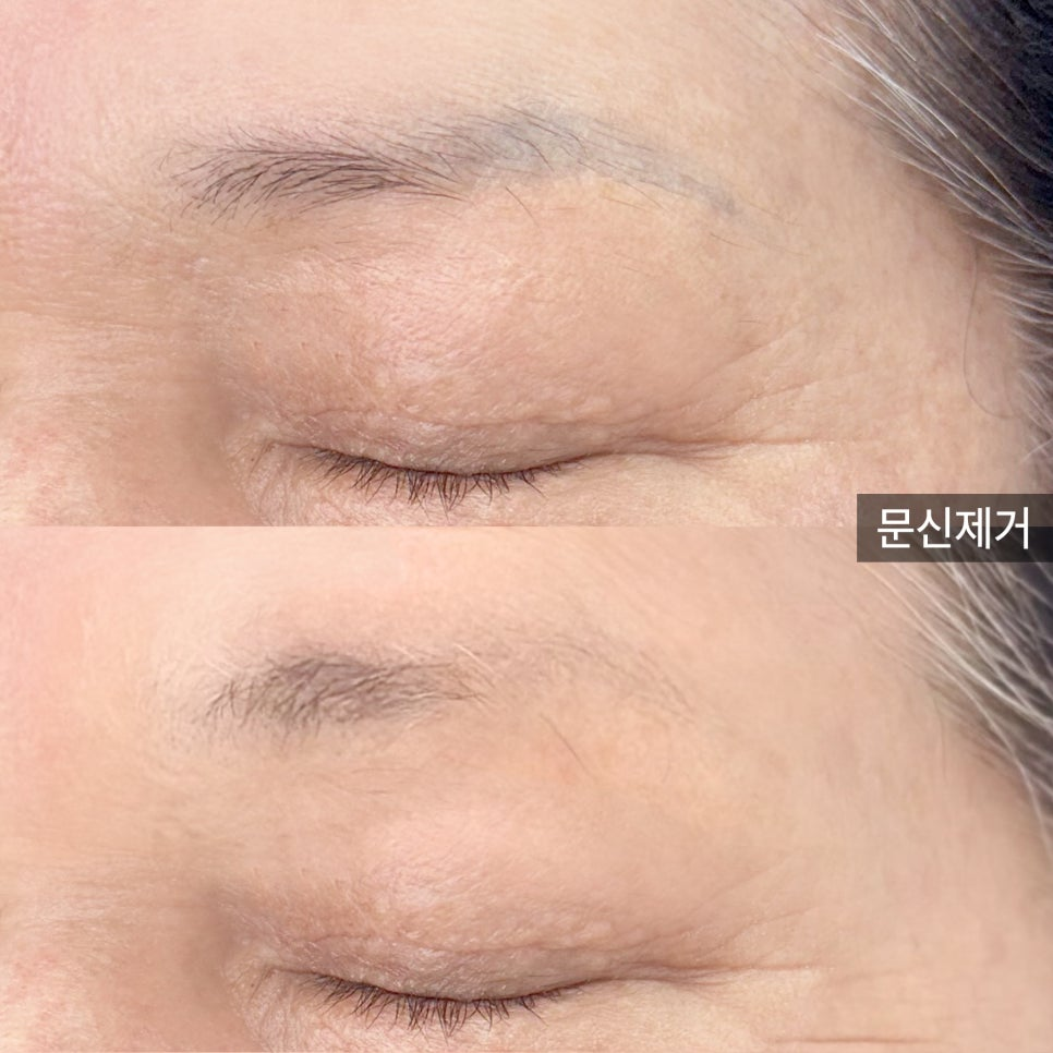 논현눈썹문신, 했던 곳에서 또하면 붉은기만 심해진다?