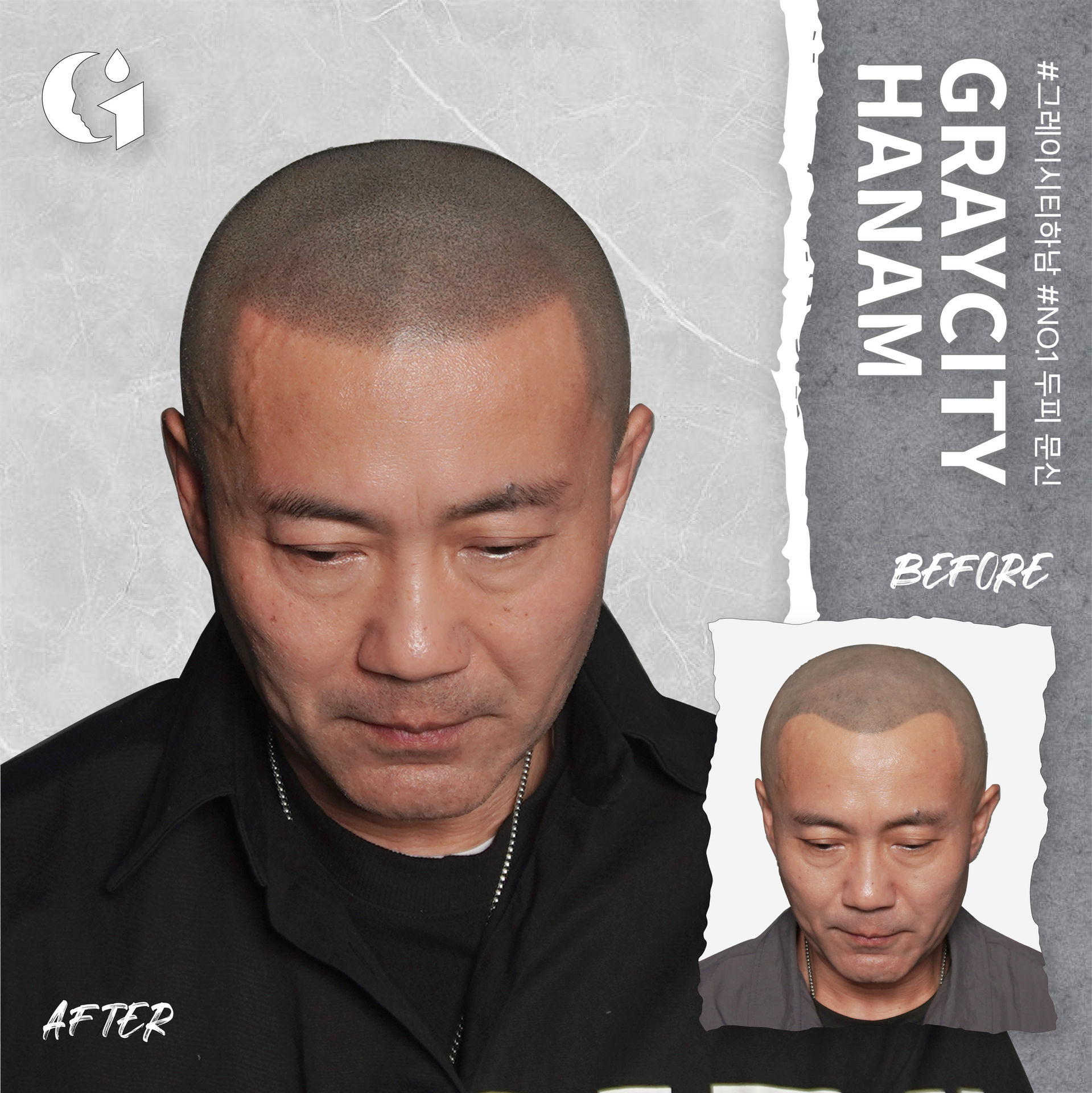 구준엽이 인정한 완벽한 탈모해결법! 두피문신. 그레이시티 하남점만의 3가지 기법으로 실제 머리카락이 자란 듯 자연스러운 입체감을 만들어드립니다.