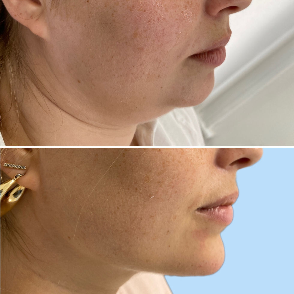 Double chin before and after