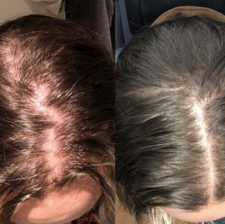 hair loss woman