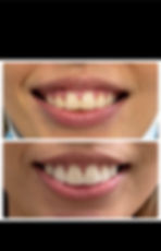 Hollywood Veneers