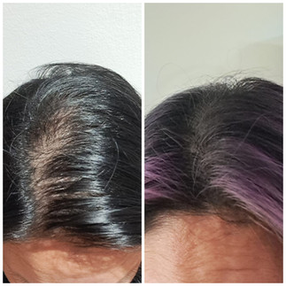 Before & After result of hair thinning treatment Singapore