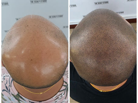 What Are the Benefits of Hairline Restoration Treatments?