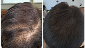 Before & After result of Hair Thinning Treatment for Women Singapore