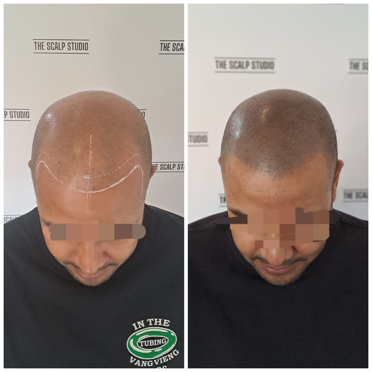 Before & After results of Buzzcut SMP by The Scalp Studio