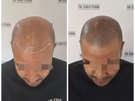 How Long Does SMP Last? Scalp Micropigmentation Longevity Explained
