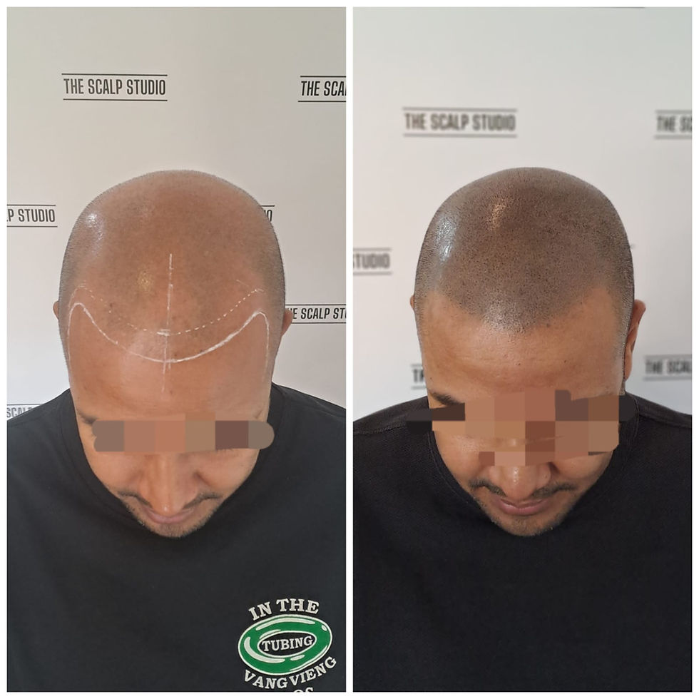 How Long Does SMP Last? Scalp Micropigmentation Longevity Explained