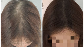 Female Pattern Hair Loss Before & After Treatment