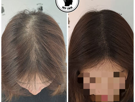 Female Pattern Hair Loss Before & After Treatment