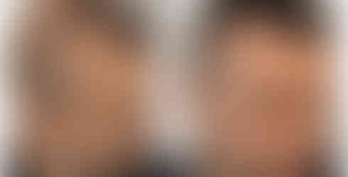 Best Scalp Micropigmentation Singapore before and after results for male pattern baldness