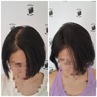 Before & After result of hair thinning treatment Singapore