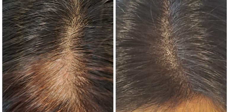 Before & After results of Female with patches by The Scalp Studio