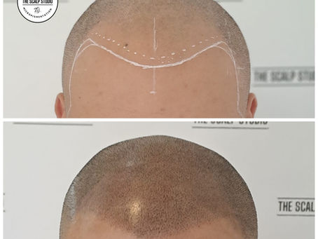 Male Pattern Baldness SG: Non-Surgical Scalp Micropigmentation Solutions