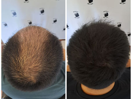 before & after result of density fill treatment Natural-Looking Scalp Micropigmentation (SMP) by The Scalp Studio in Singapore