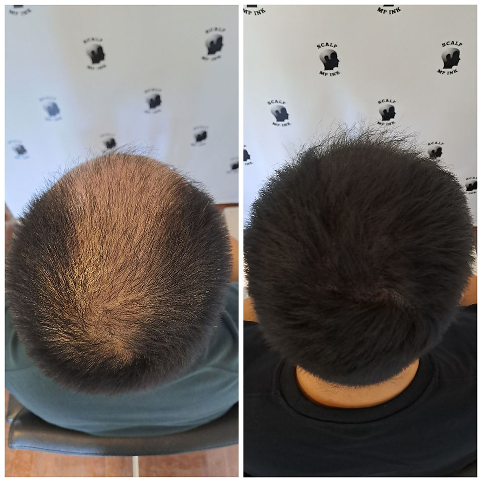 Male Crown Density Fill Before & After results of Scalp Micropigmentation (SMP) by The Scalp Studio Singapore