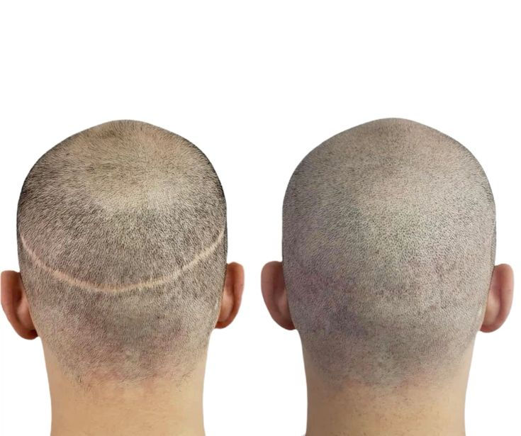 Hair transplant scar camouflage