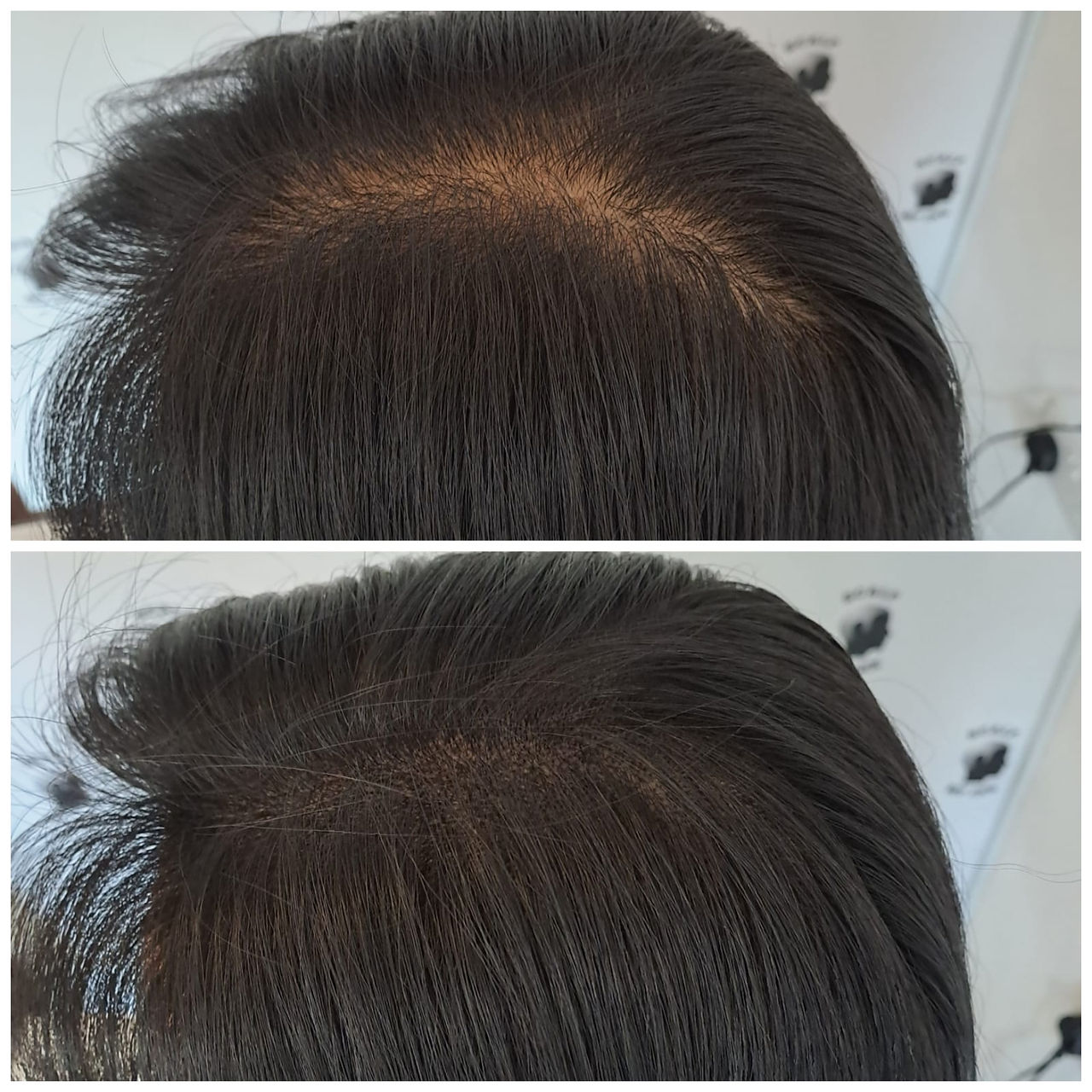 before & after result of density fill treatment Natural-Looking Scalp Micropigmentation (SMP) by The Scalp Studio in Singapore