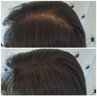 Before & After result of hair thinning treatment Singapore