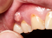 Swelling on the gum