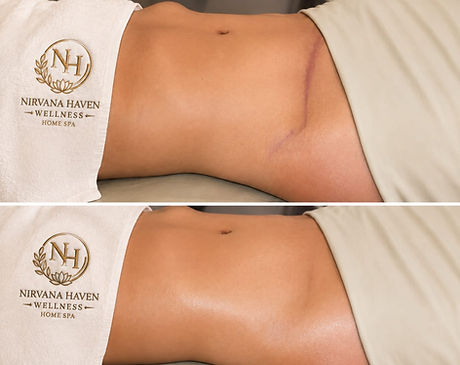 Lymphatic massage after tummy tuck.jpeg