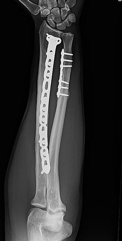 Carousel pic - Radius ORIF