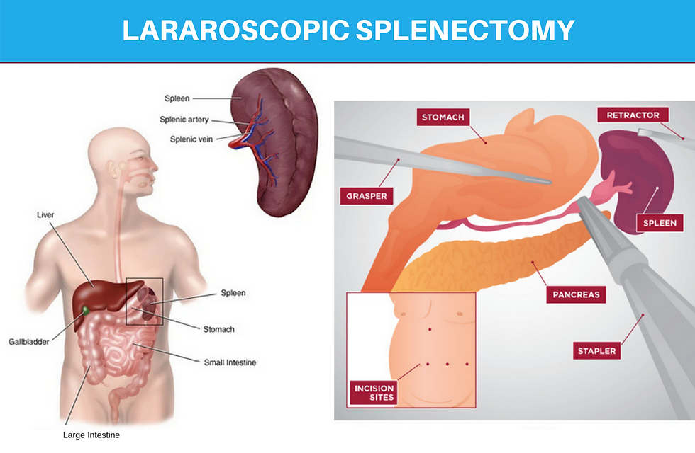 LARAROSCOPIC SPLENECTOMY.png