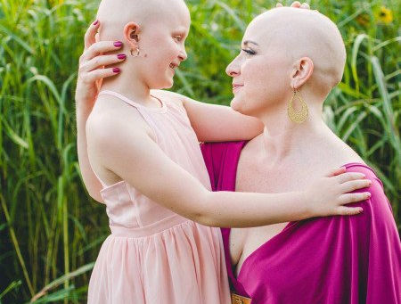 ALOPECIA AREATA.