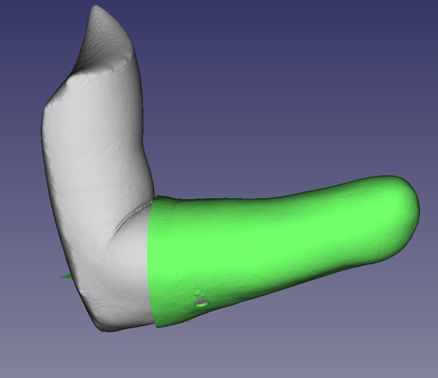 3d scan prothese arm amputation