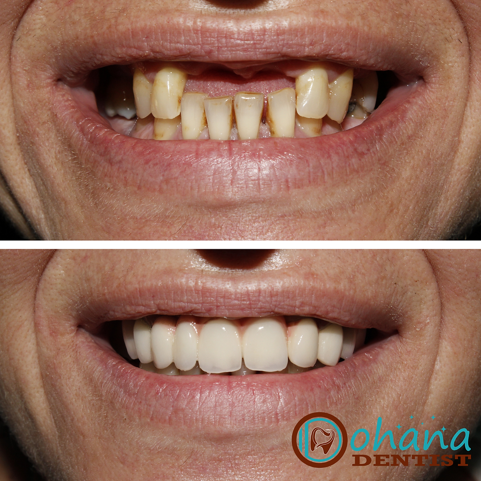 Metalokeramički most