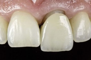 corona-dental-clinica-dental-denty-smile