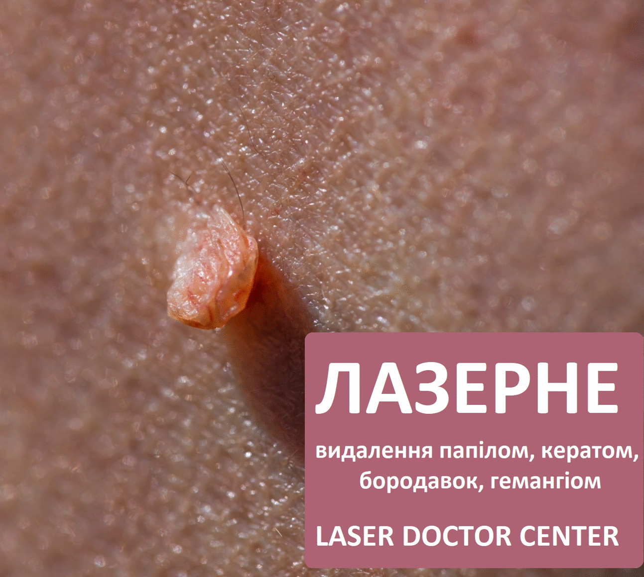 удаление папиллом