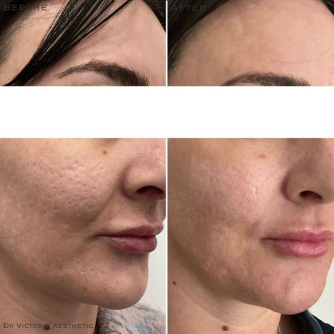 Dr Victoria Aesthetic Before & After. Polynucleotides Sculptra Profhilo Dermal Fillers Skin Peels Female Rejuvenation Muscle Relaxing Injections Medical Skin Care Aesthetics