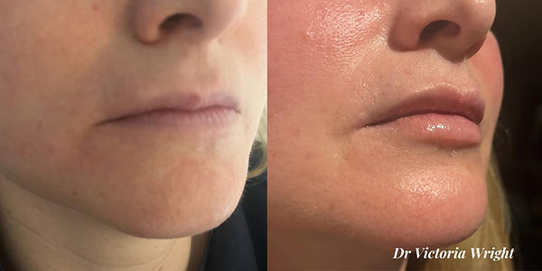 Dermal Fillers.jpg