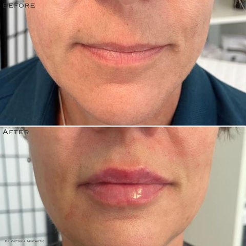 Dr Victoria Aesthetic Before & After. Polynucleotides Sculptra Profhilo Dermal Fillers Skin Peels Female Rejuvenation Muscle Relaxing Injections Medical Skin Care Aesthetics