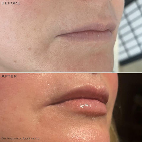 Dr Victoria Aesthetic Before & After. Polynucleotides Sculptra Profhilo Dermal Fillers Skin Peels Female Rejuvenation Muscle Relaxing Injections Medical Skin Care Aesthetics
