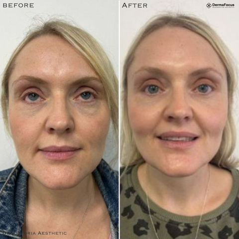 Dr Victoria Aesthetic Before & After. Polynucleotides Sculptra Profhilo Dermal Fillers Skin Peels Female Rejuvenation Muscle Relaxing Injections Medical Skin Care Aesthetics
