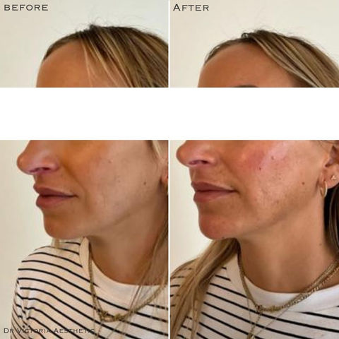 Dr Victoria Aesthetic Before & After. Polynucleotides Sculptra Profhilo Dermal Fillers Skin Peels Female Rejuvenation Muscle Relaxing Injections Medical Skin Care Aesthetics