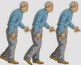 yürüyüş bozukluğu.jpg