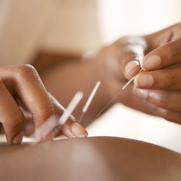 treat-02-acupuncture_2x.jpg