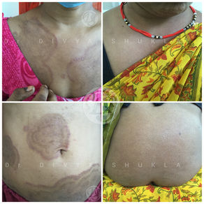 "Understanding and Treating Fungal Skin Infections: A Comprehensive Guide"