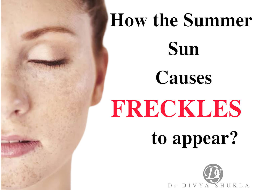 How the Summer Sun Causes Freckles to Appear ?