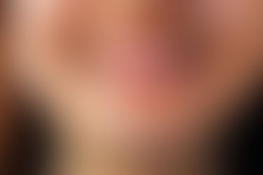 How To Prepare For Mole Removal ?