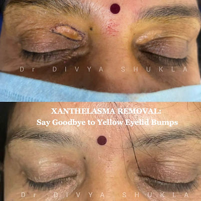 Scarless Xanthelasma Removal