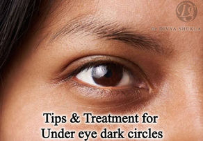 "How to effectively reduce dark circles: Tips and treatments for brighter, refreshed under-eyes"