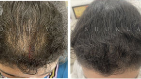 "Effective Treatment Options for Female Pattern Hair Loss: What Really Works?"