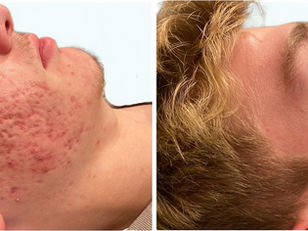 Male acne patient before and after AcneFix treatment in Houston — clear skin achieved without antibiotics