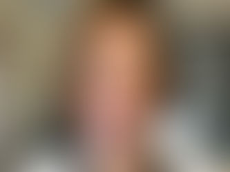 塗る針andヒト幹細胞で即効肌再生体験してみた件。。。