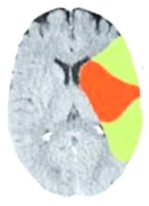 Greyscale imaging of brain with orange and green markers of stroke location and progression at 60 minutes