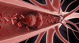 Illustration of an artery showing Ischemic Stroke blood clot