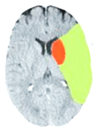 Greyscale imaging of brain with orange and green markers of stroke location and progression at 10 minutes